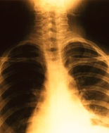 L’embolia polmonare colpisce il 17% dei ricoverati per un primo episodio di sincope